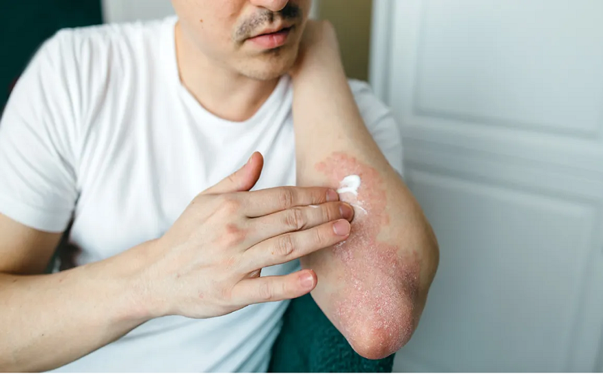 What is the Best Type of Psoriasis Treatment?